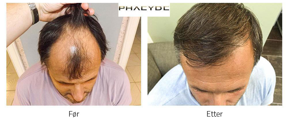 Hårtransplantasjon Michael K. 4000 hår