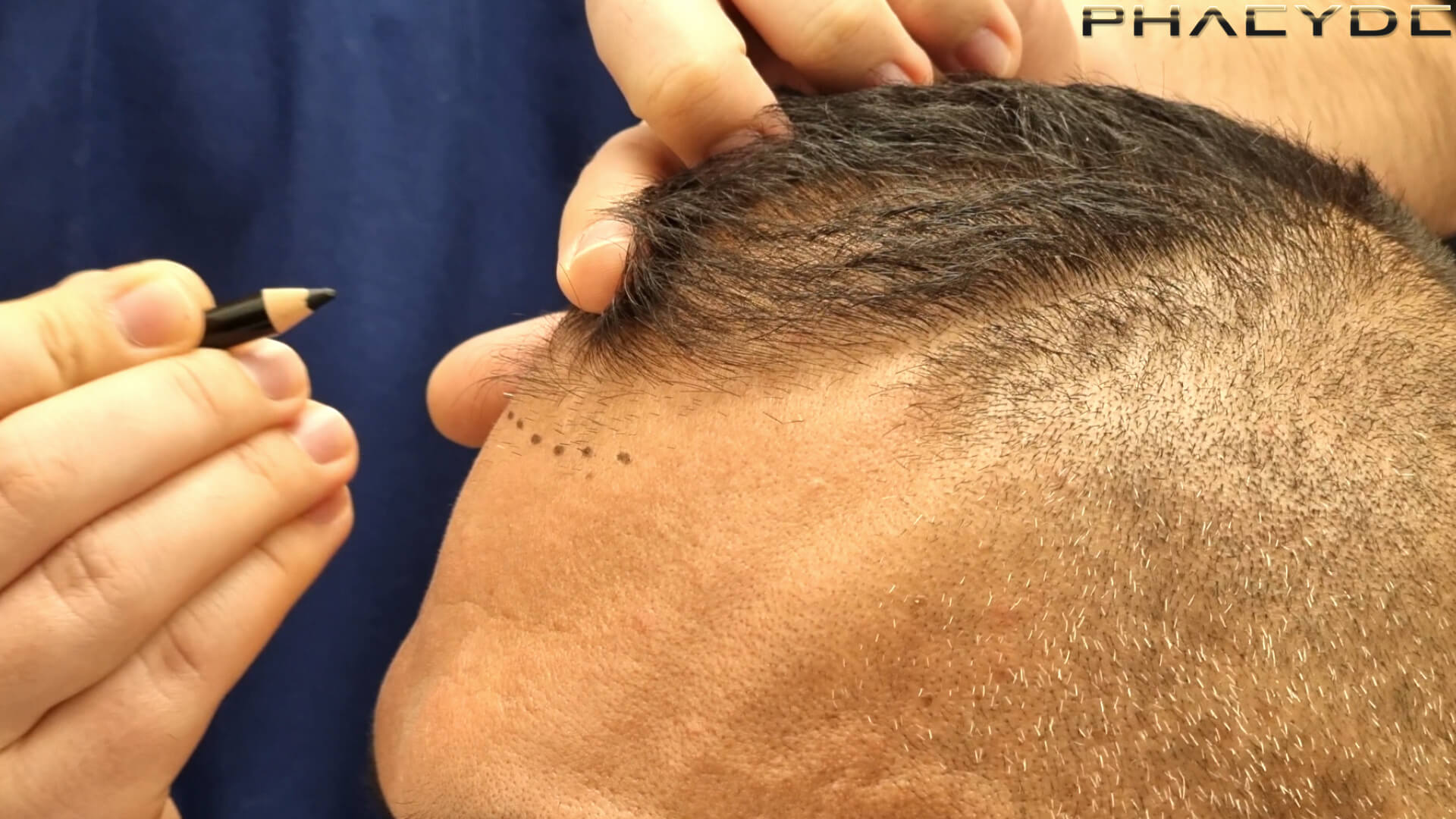PHAEYDE Hair Transplant Clinic PHAEYDE Hair Transplant Clinic