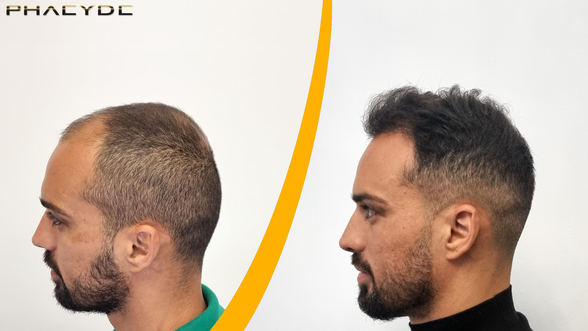 Transplant de Păr - Rezultat Înainte și După Transplant de Păr - Rezultat Înainte și După