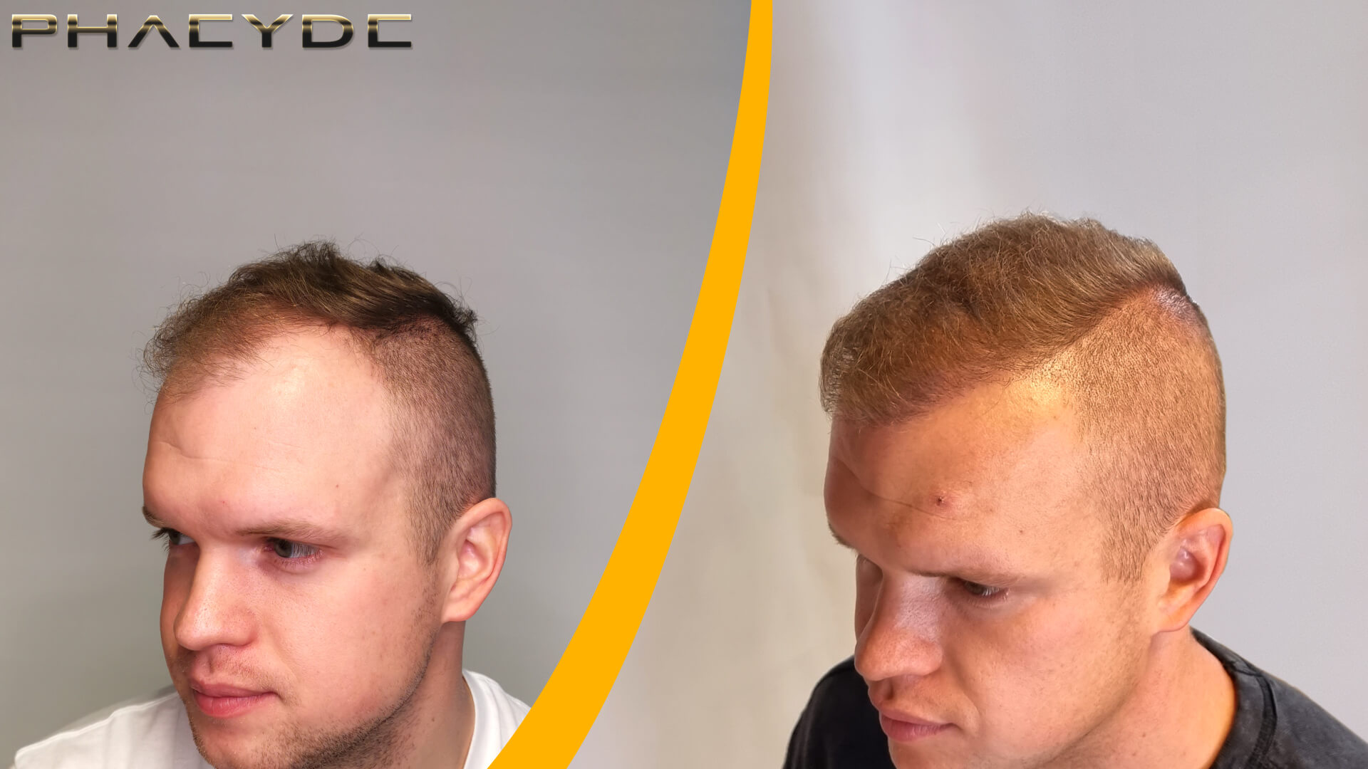 Patrik: Înainte- După Transplantul de Păr Patrik: Înainte- După Transplantul de Păr