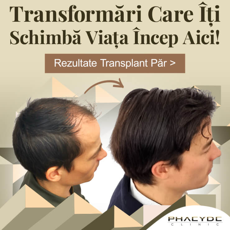 Implant de păr No.1 transplantul de păr