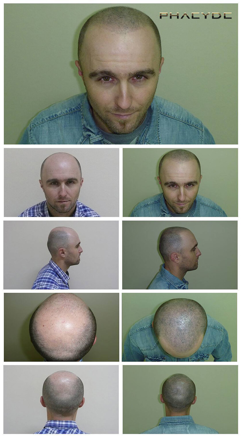 Before After Hair Pigmentation Photos at PHAEYDE Clinic