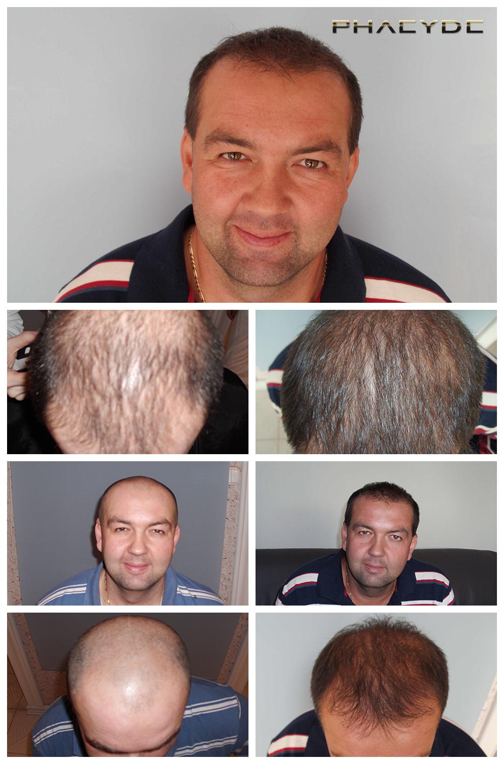 transplant de păr elvețian anti-îmbătrânire